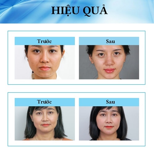 Hướng dẫn sử dụng Kem Kone Thái Lan hiệu quả nhất